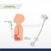 Simplex Gastrostomy Feeding Tube Simplex Gastrostomy Feeding Tube
